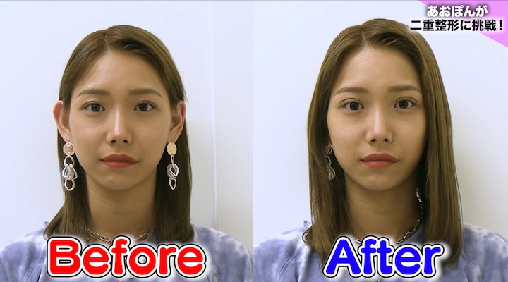 あおぽんさん二重整形BeforeAfter